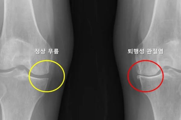 Прогнозирование вероятности развития остеоартрита с помощью ИИ  (Южная Корея)