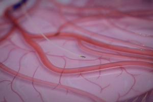 Магнитный микрокатетер – будущее сосудистой хирургии (Гонконг)