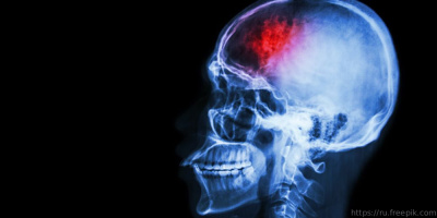 Вебинар «Постинсультные психические нарушения», 14 марта 2022 года