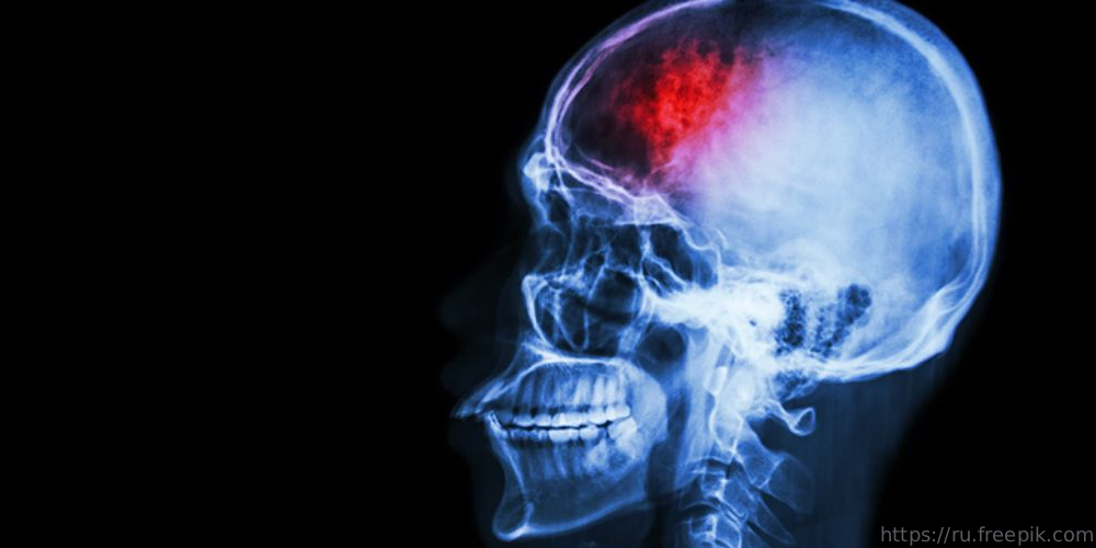 Вебинар «Постинсультные психические нарушения», 14 марта 2022 года