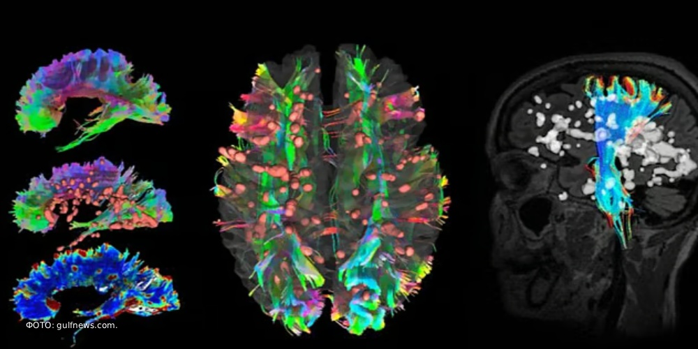 Новый подход к диагностике рассеянного склероза