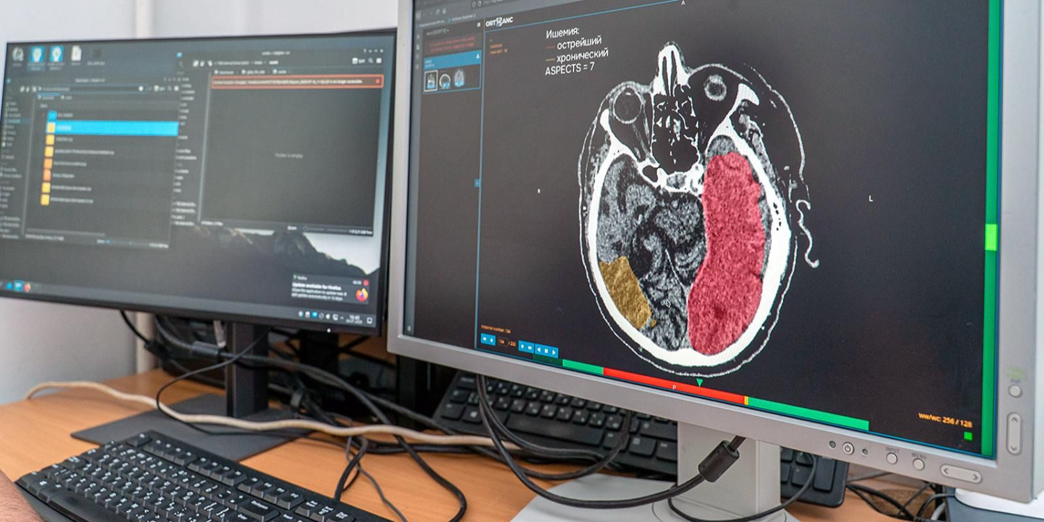 Инновационная диагностика инсульта